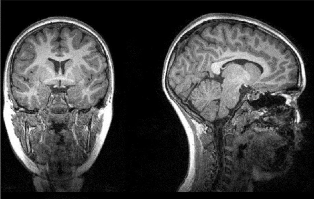 La COVID-19 altera el volumen de materia gris en el cerebro, según un estudio