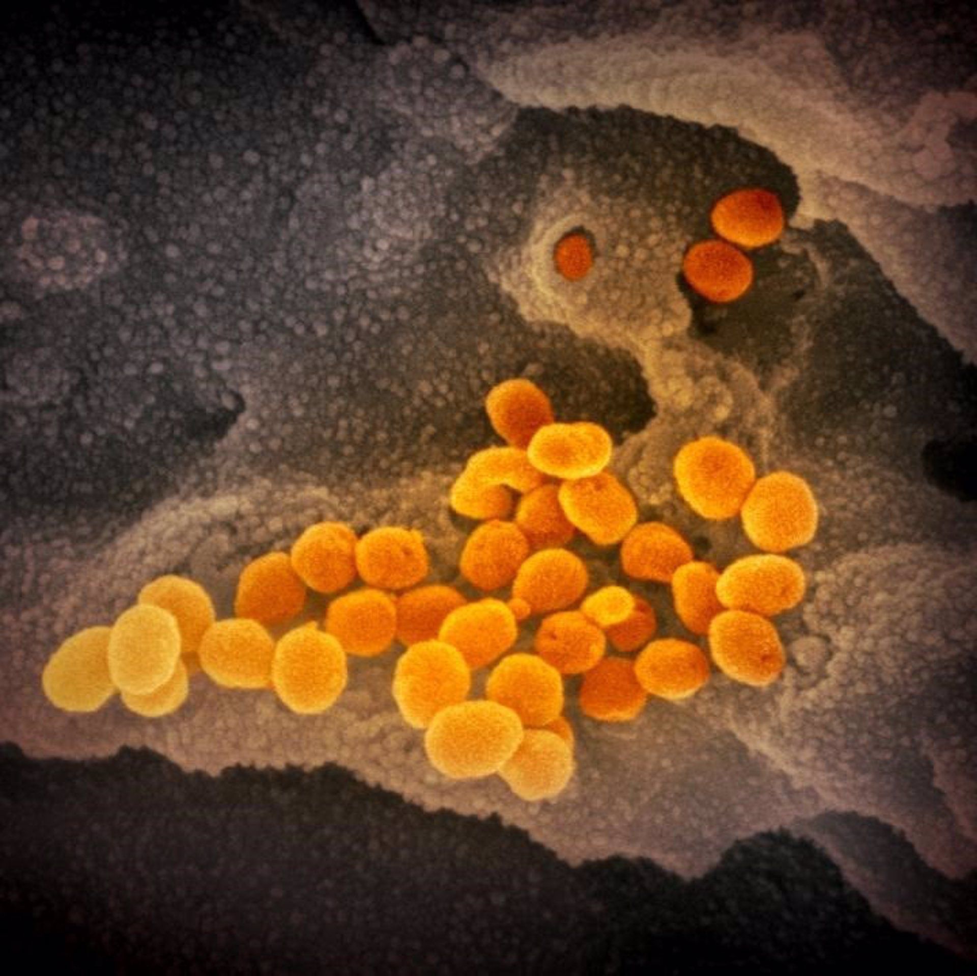 Esta imagen de microscopio electrónico de barrido muestra el SARS-CoV-2 (naranja), el virus que causa la COVID-19. EP