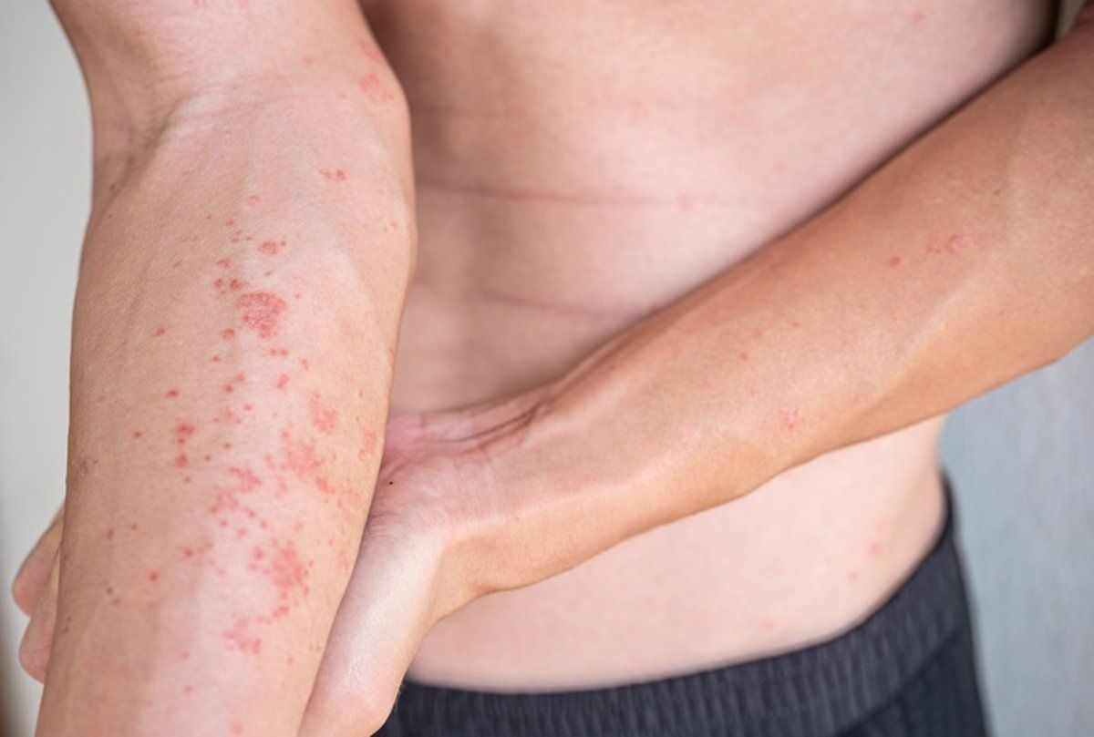 Eczema dermatitis. Foto Infosalus