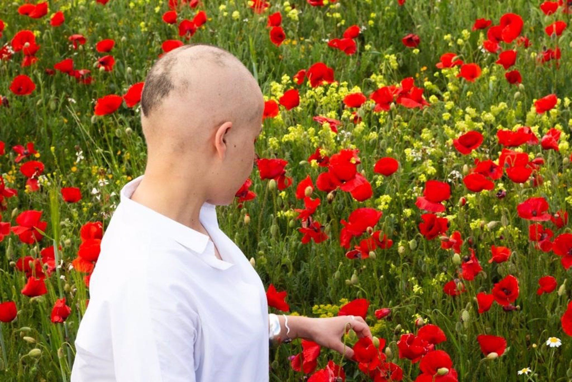 Alopecia femenina. Foto de archivo