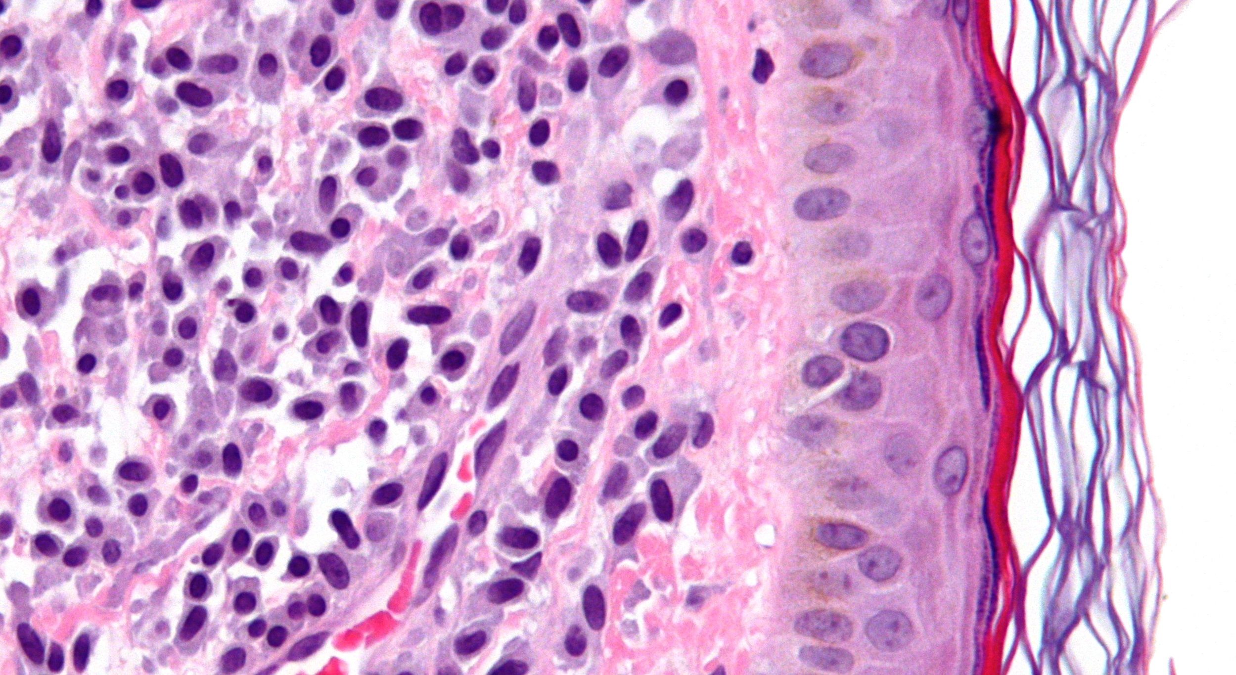 El sistema inmune está involucrado en el desarrollo de la mastocitosis. Foto USAL 